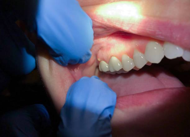 Best Emergency Care for Gum Disease in China Spring, TX